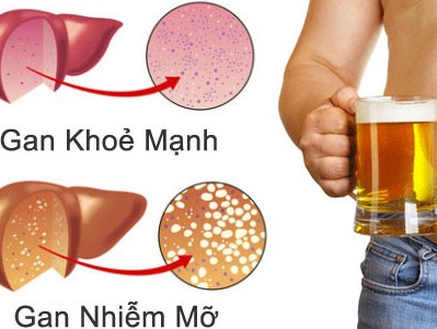 gan nhiễm mỡ